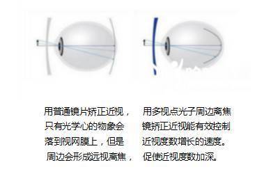孩子眼睛度數持續(xù)加深？光學鏡片選擇與科學防控是關鍵